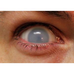 Контактные линзы-склеры белые катаракта