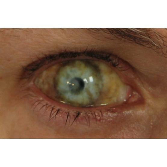 Контактные линзы-склеры Мертвый глаз фото 1