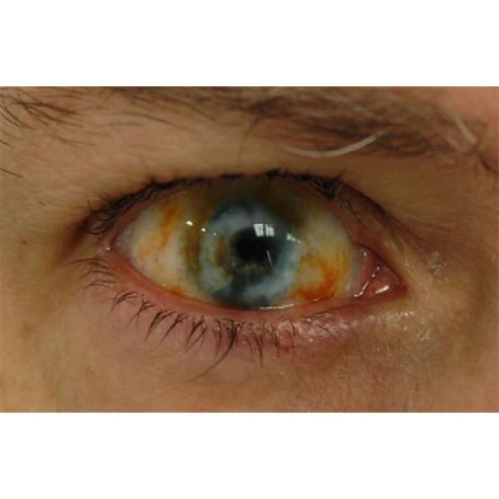 Контактные линзы-склеры Зомби глаз фото 1