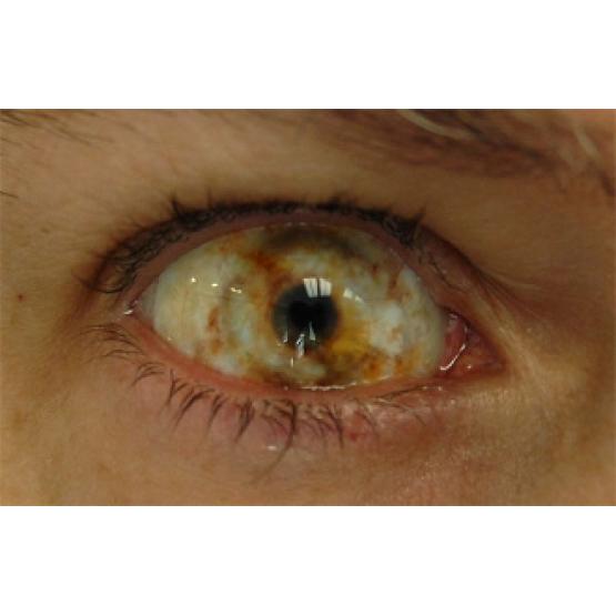 Контактные линзы-склеры Зомби глаз фото 2