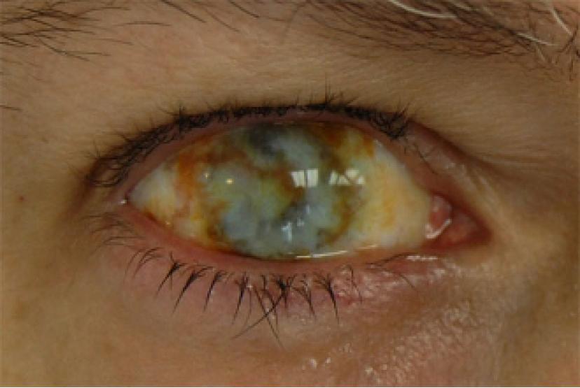 Контактные линзы-склеры Зомби глаз фото 